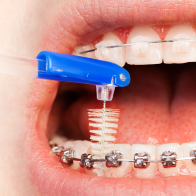 Choosing the Right Age for Braces