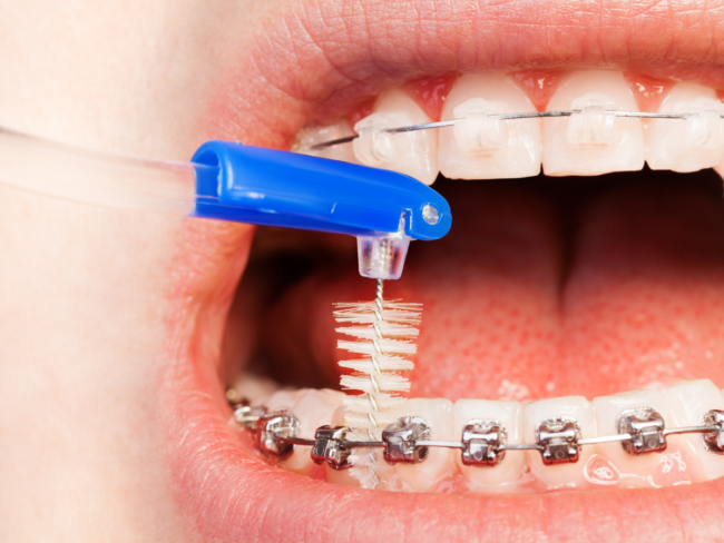 Choosing the Right Age for Braces
